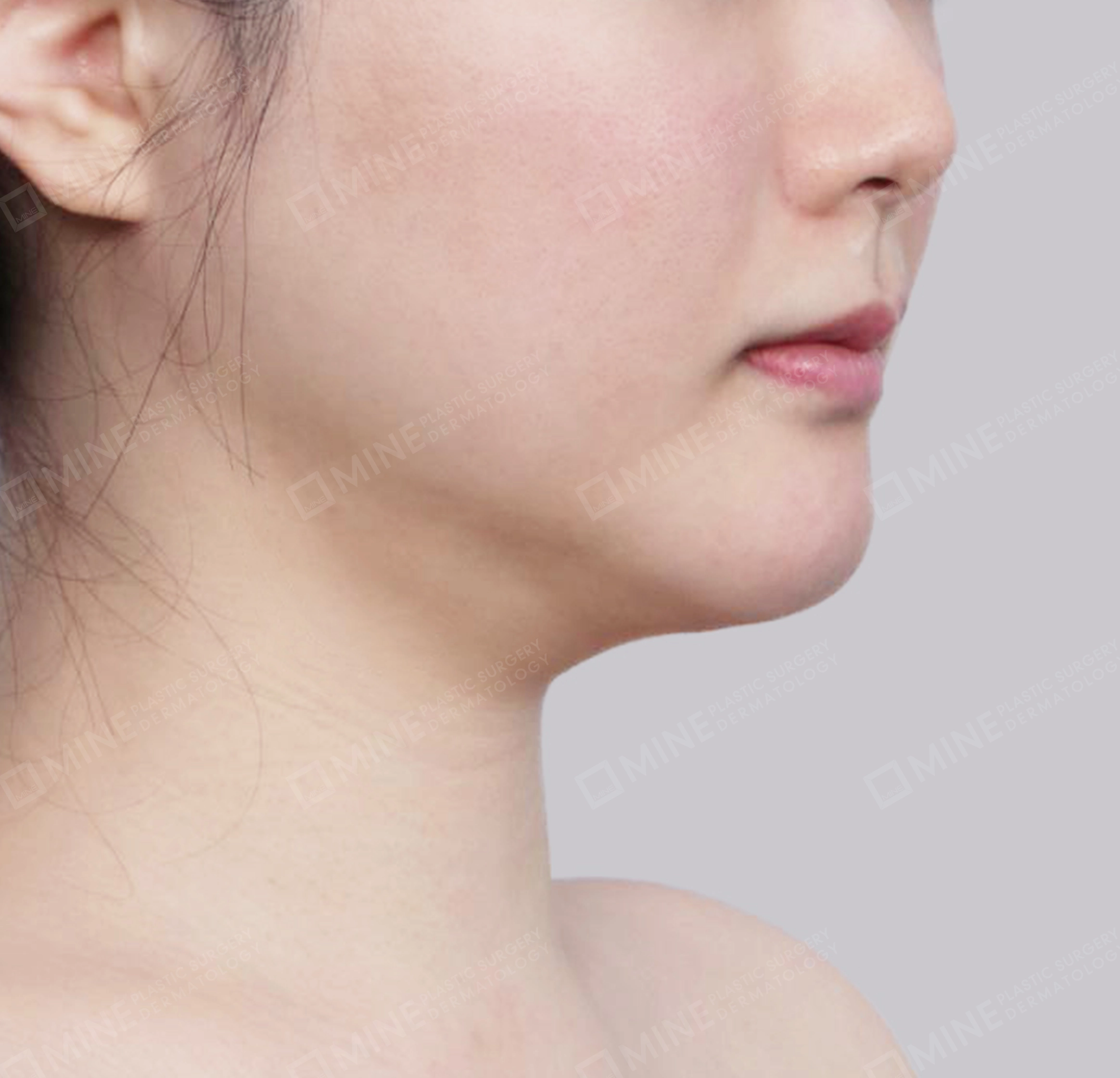 Vlimming (Dagu Ganda) + Eksisi kelenjar submandibula-Depan-Sebelum