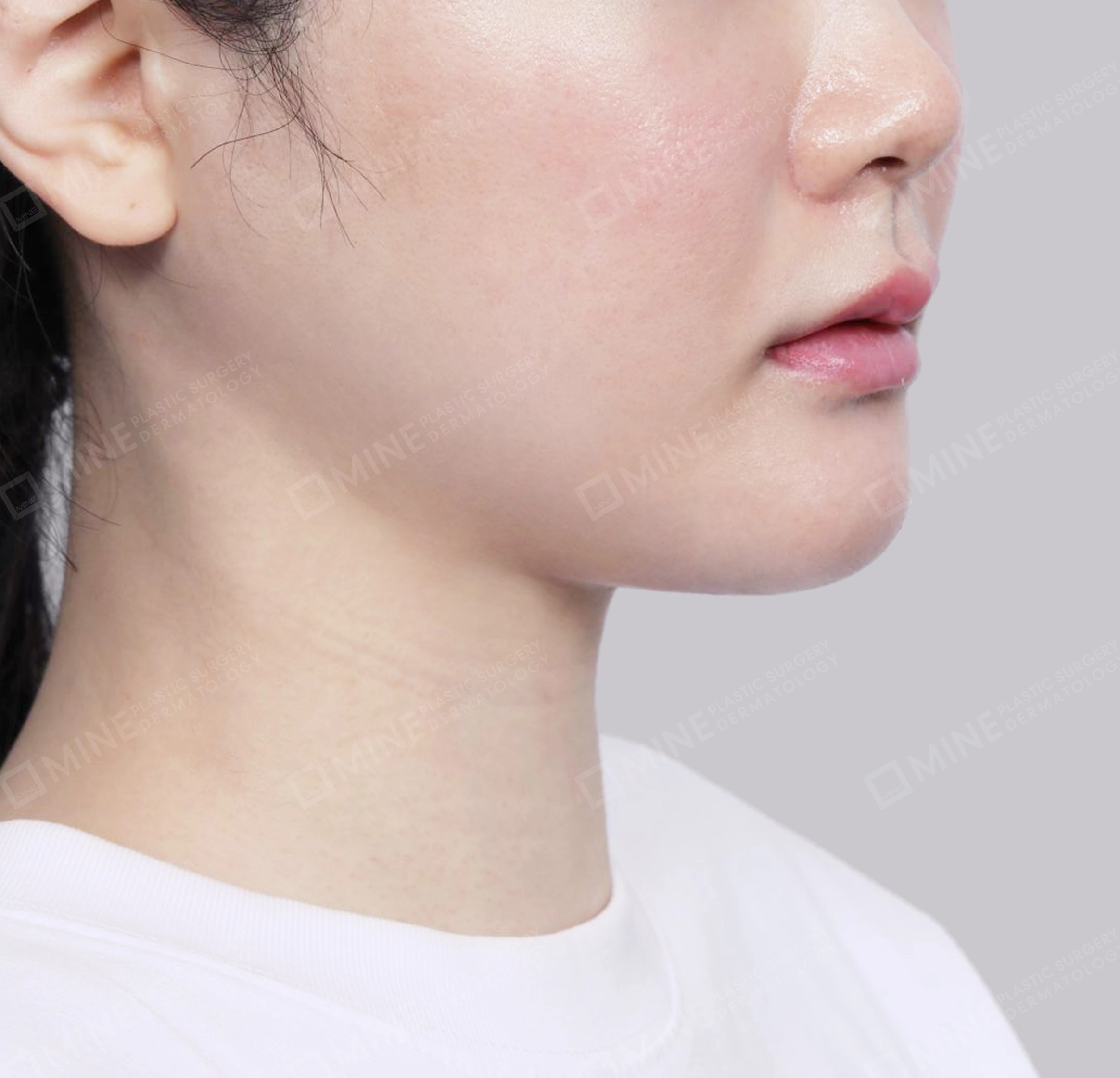 Vlimming (Dagu Ganda) + Eksisi kelenjar submandibula-Depan-Sesudah