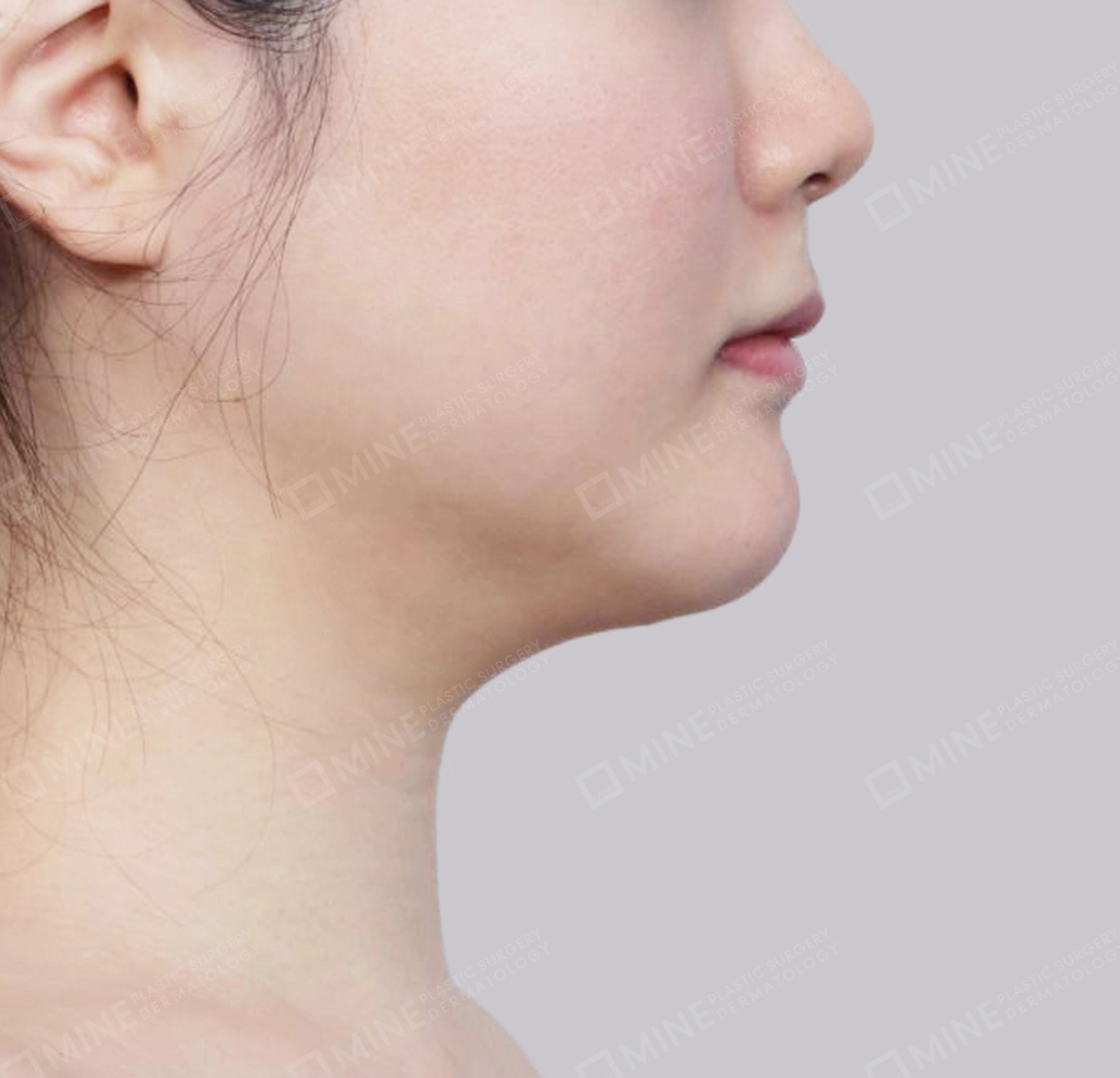 Vlimming (Dagu Ganda) + Eksisi kelenjar submandibula-Samping-Sebelum