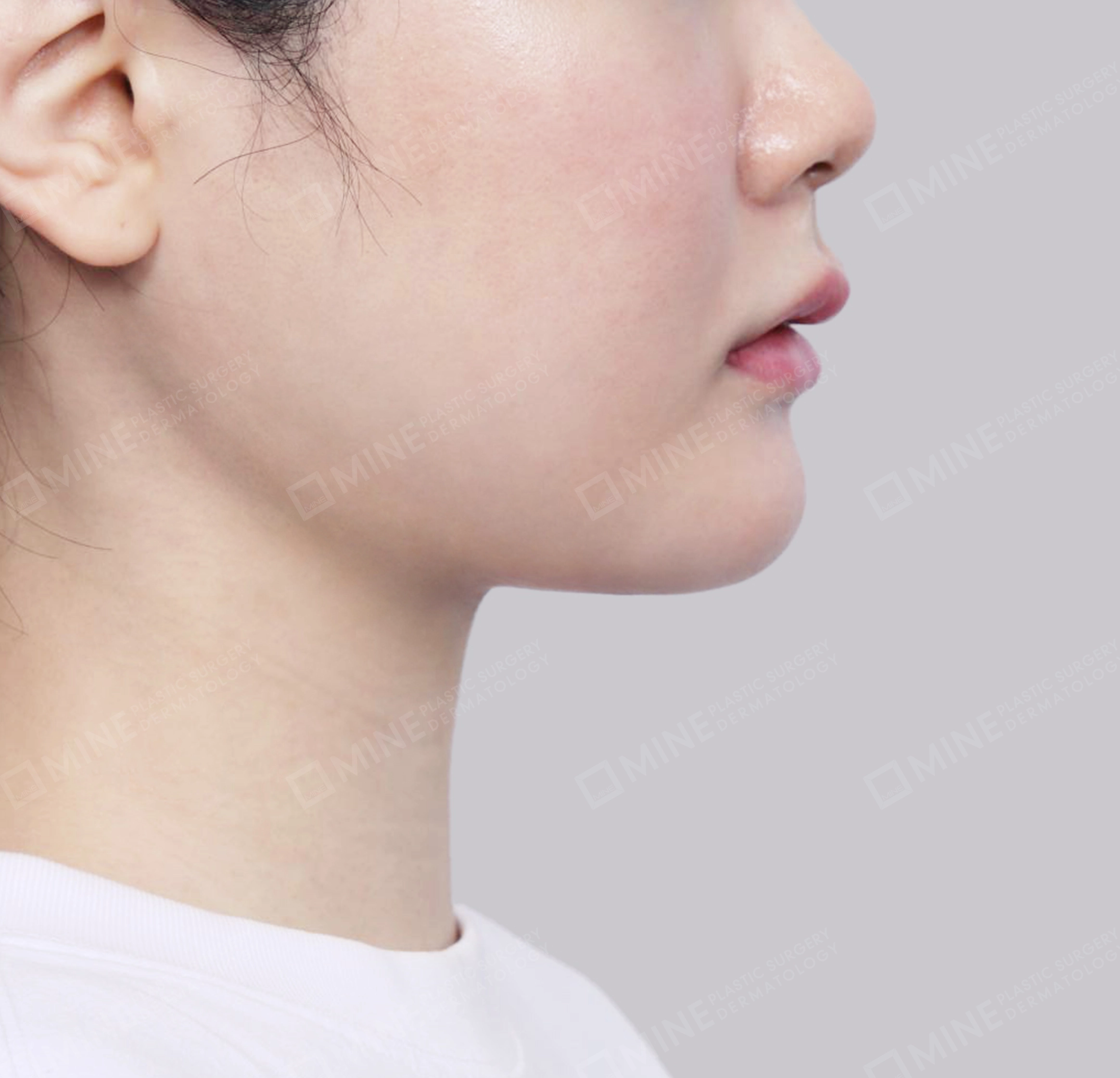 Vlimming (Dagu Ganda) + Eksisi kelenjar submandibula-Samping-Sesudah