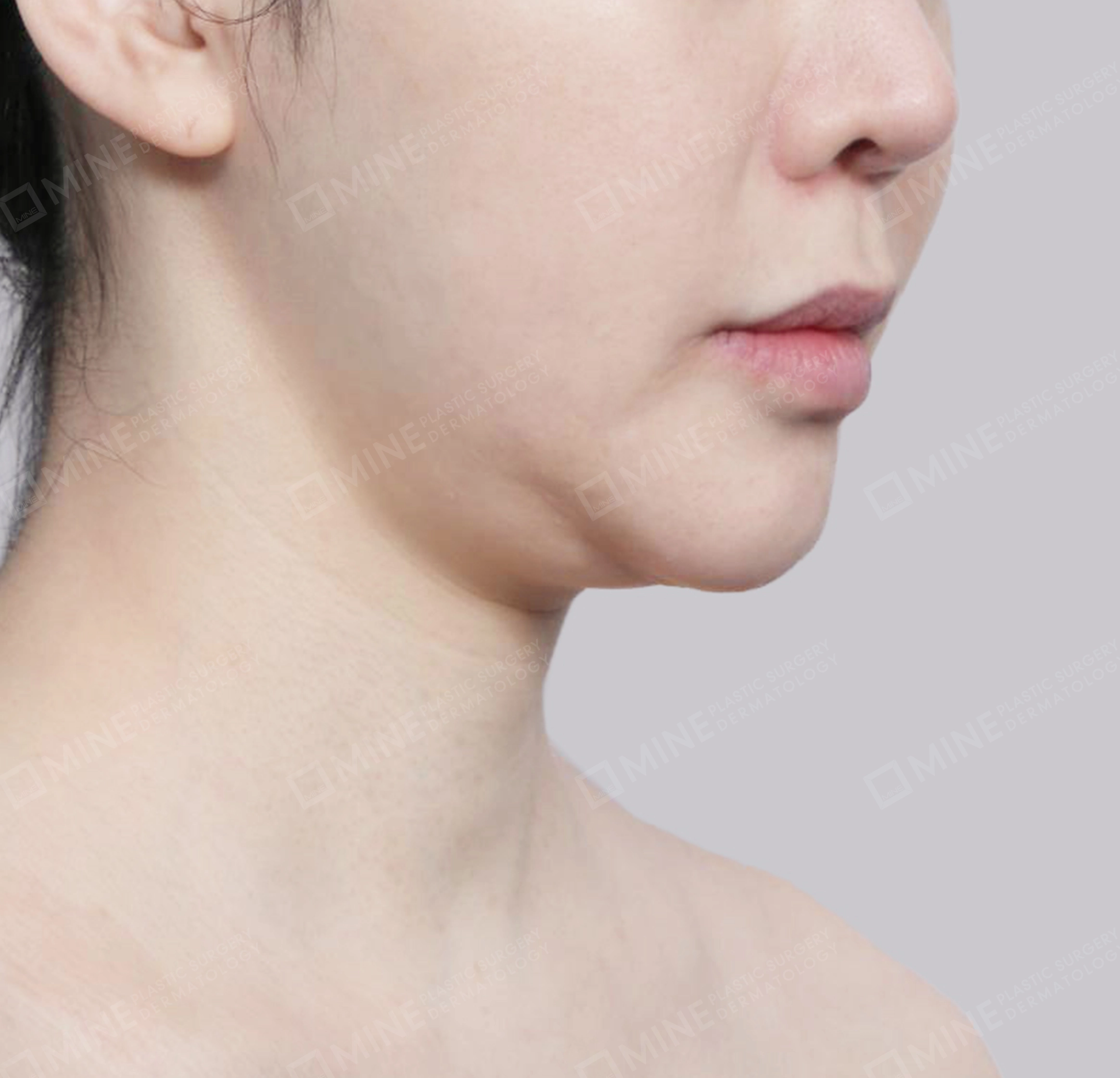 Vlimming (Dagu Ganda) + Eksisi kelenjar submandibula-Depan-Sebelum