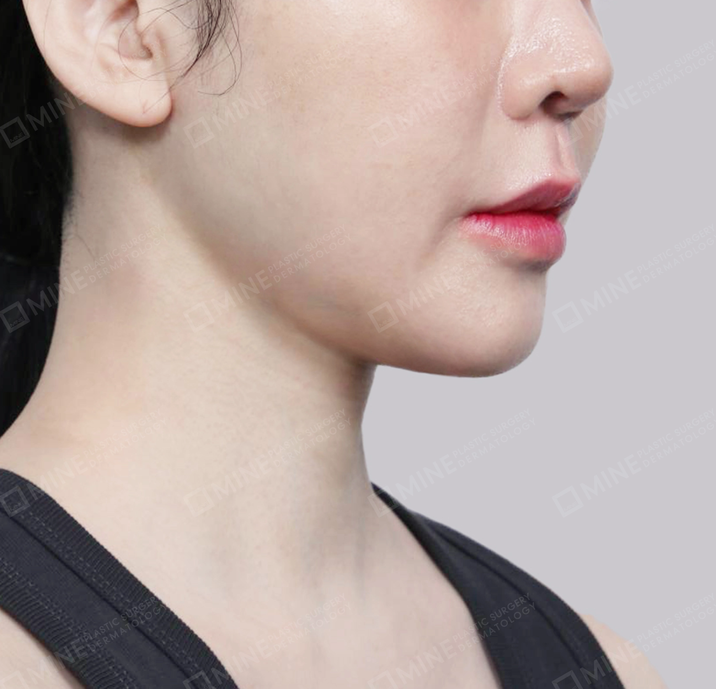 Vlimming (Dagu Ganda) + Eksisi kelenjar submandibula-Depan-Sesudah