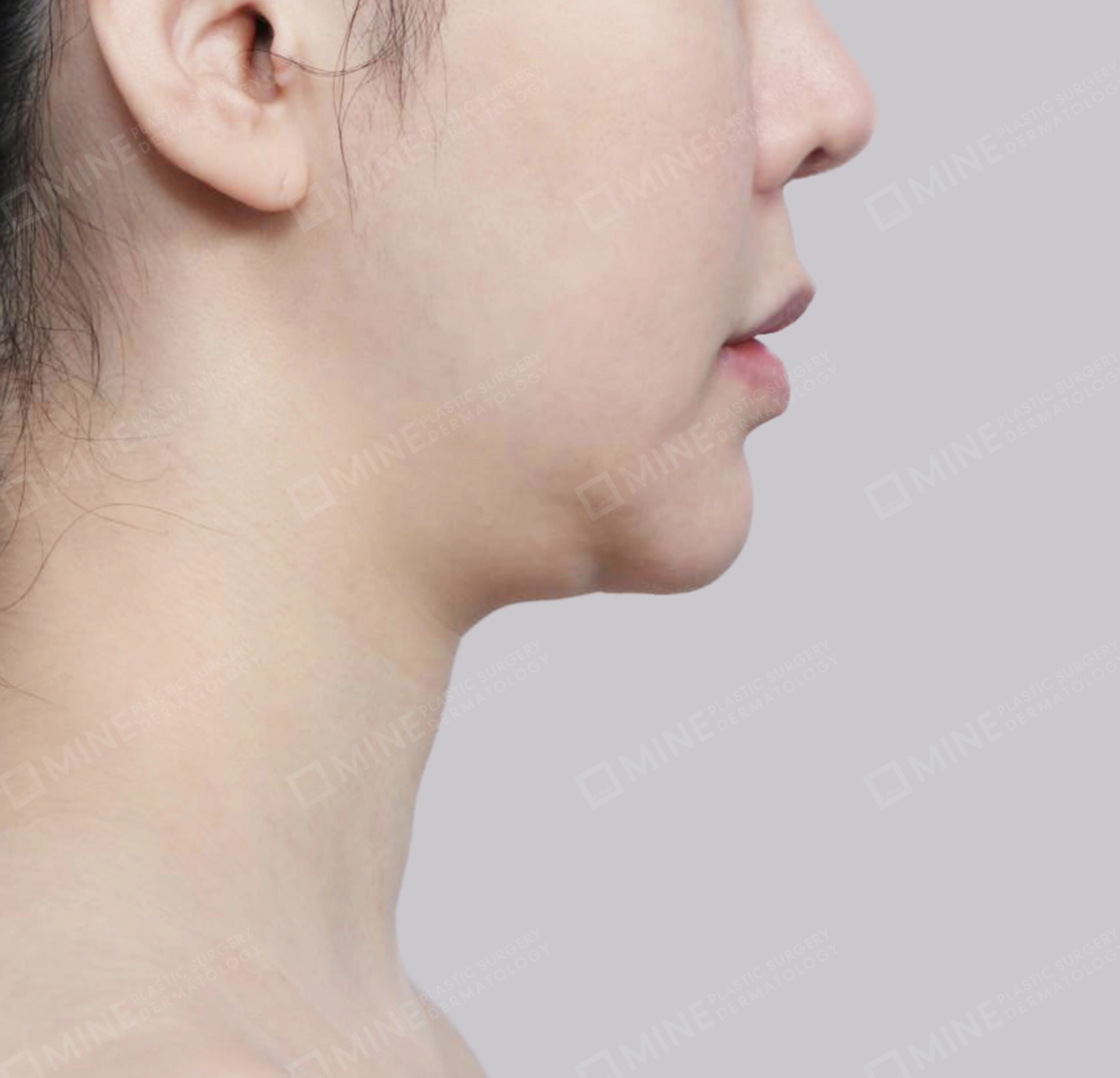 Vlimming (Dagu Ganda) + Eksisi kelenjar submandibula-Samping-Sebelum