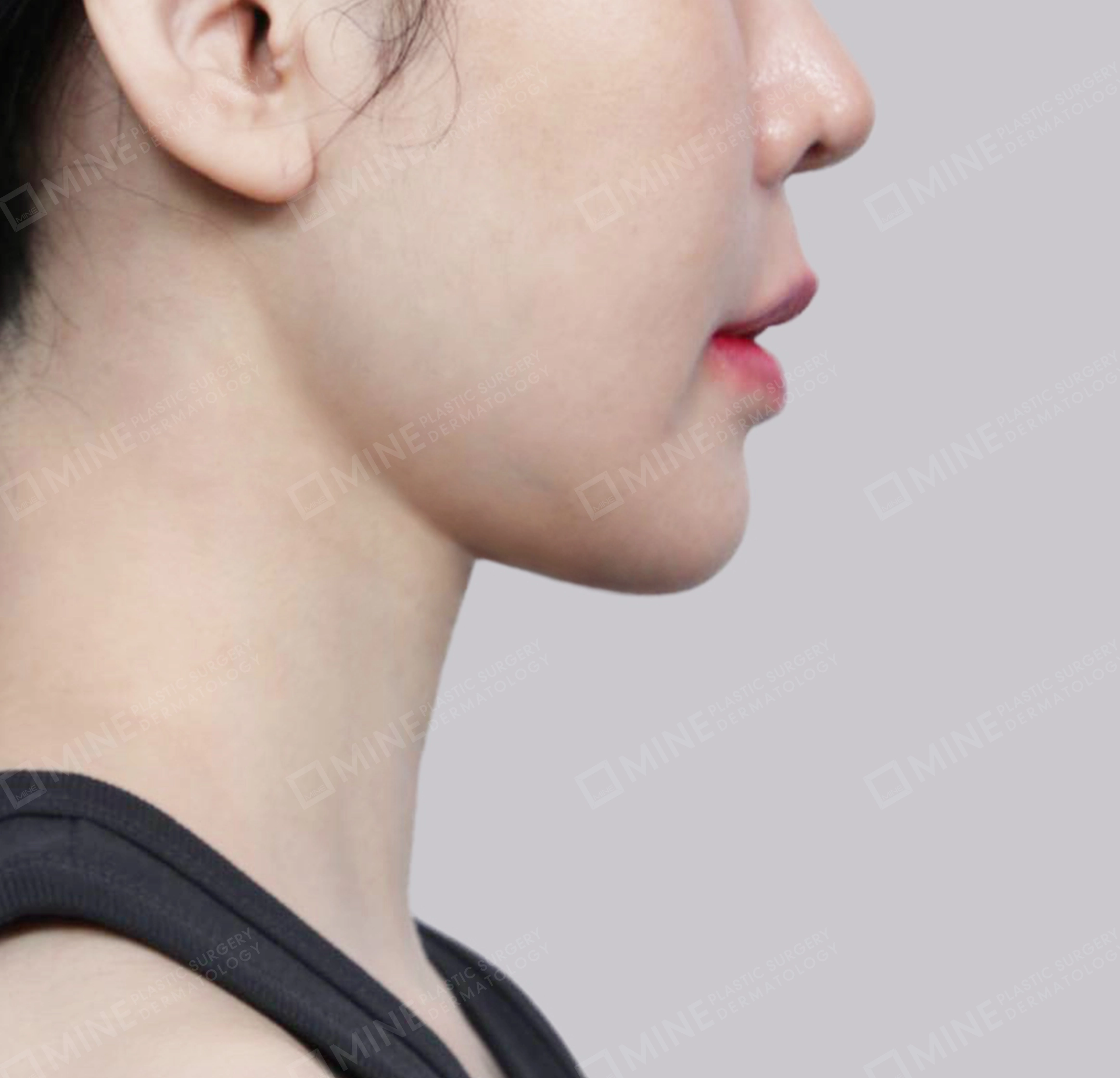 Vlimming (Dagu Ganda) + Eksisi kelenjar submandibula-Samping-Sesudah