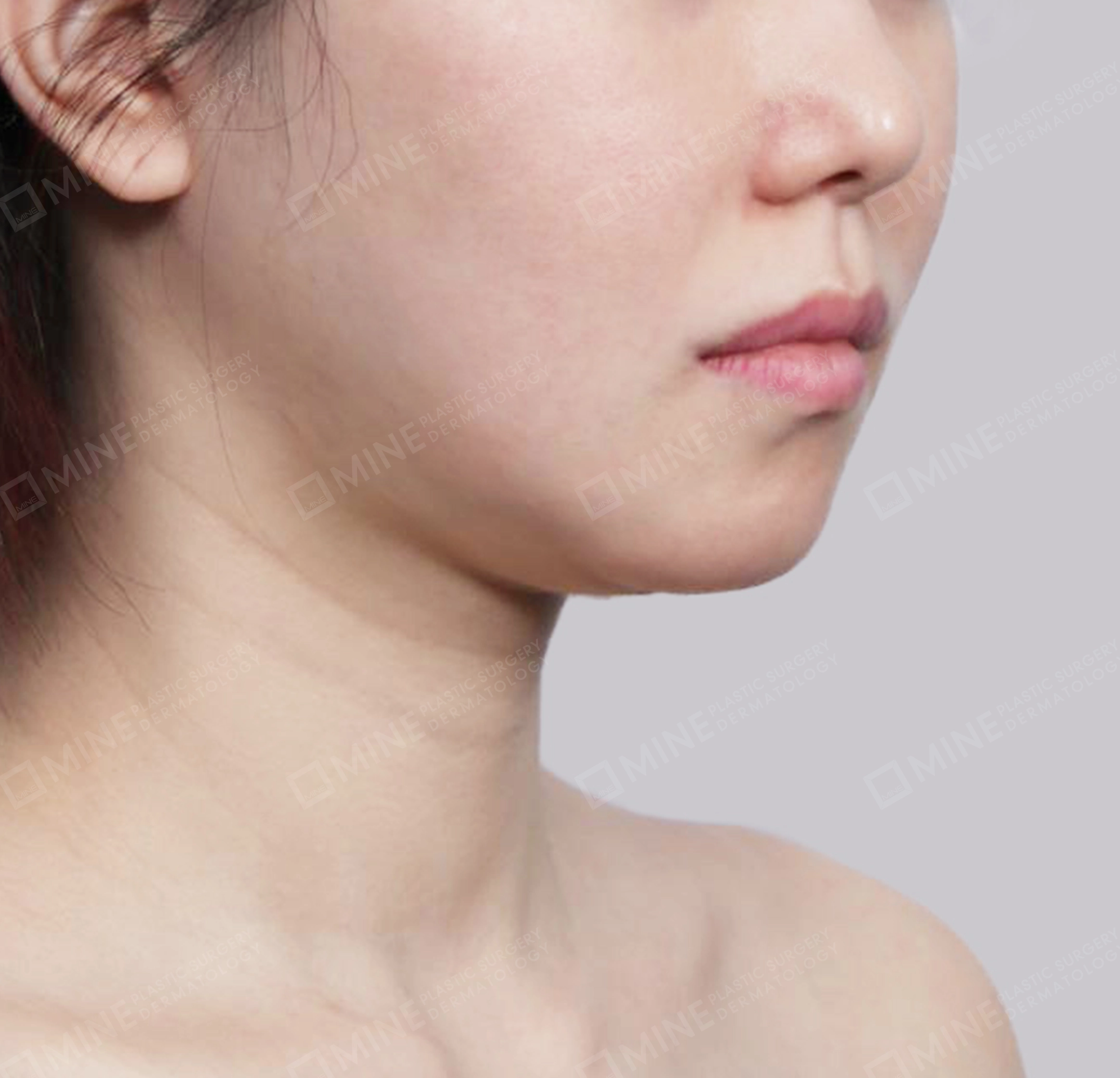 Vlimming (Dagu Ganda) + Eksisi kelenjar submandibula-Depan-Sebelum