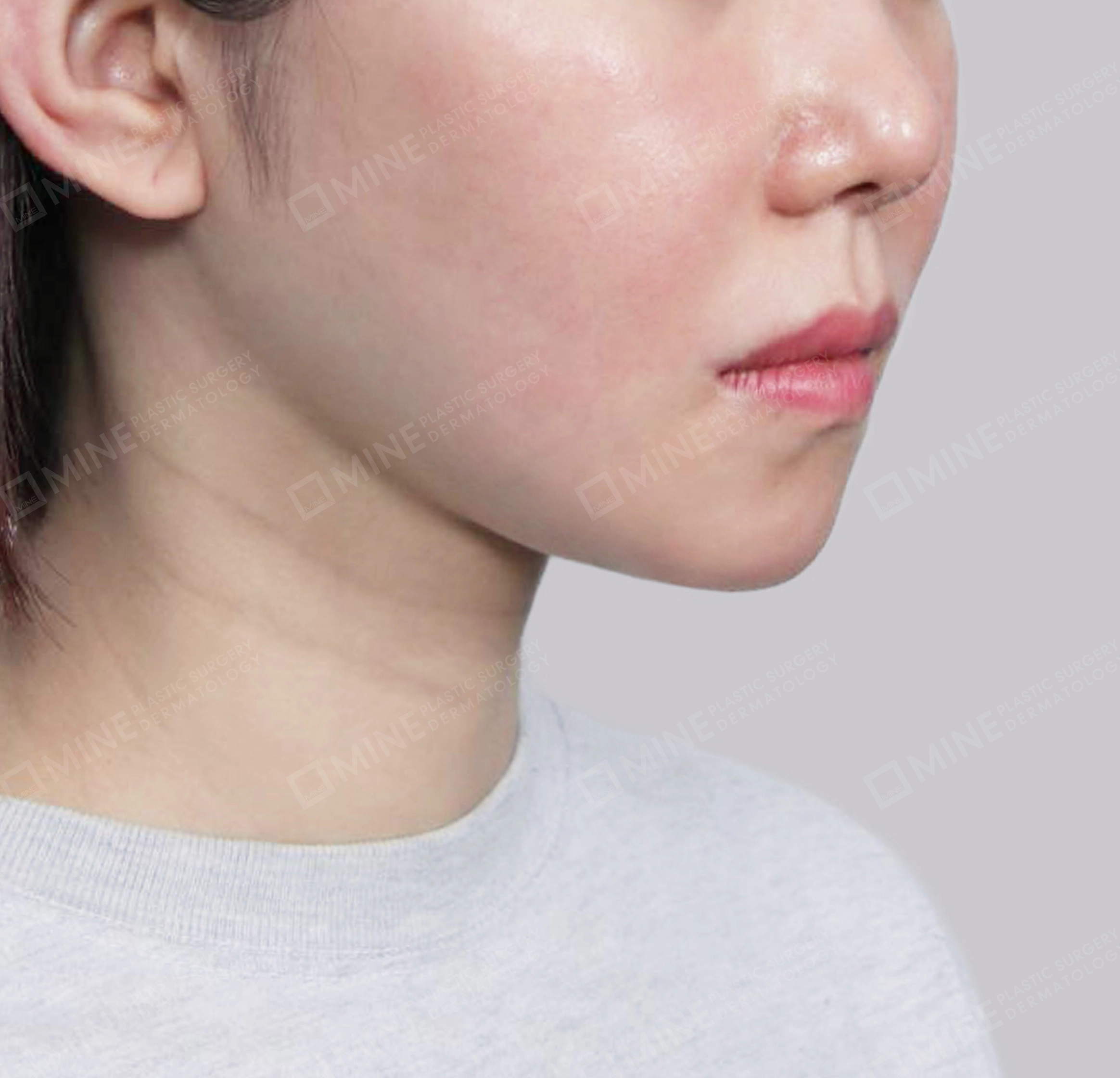 Vlimming (Dagu Ganda) + Eksisi kelenjar submandibula-Depan-Sesudah