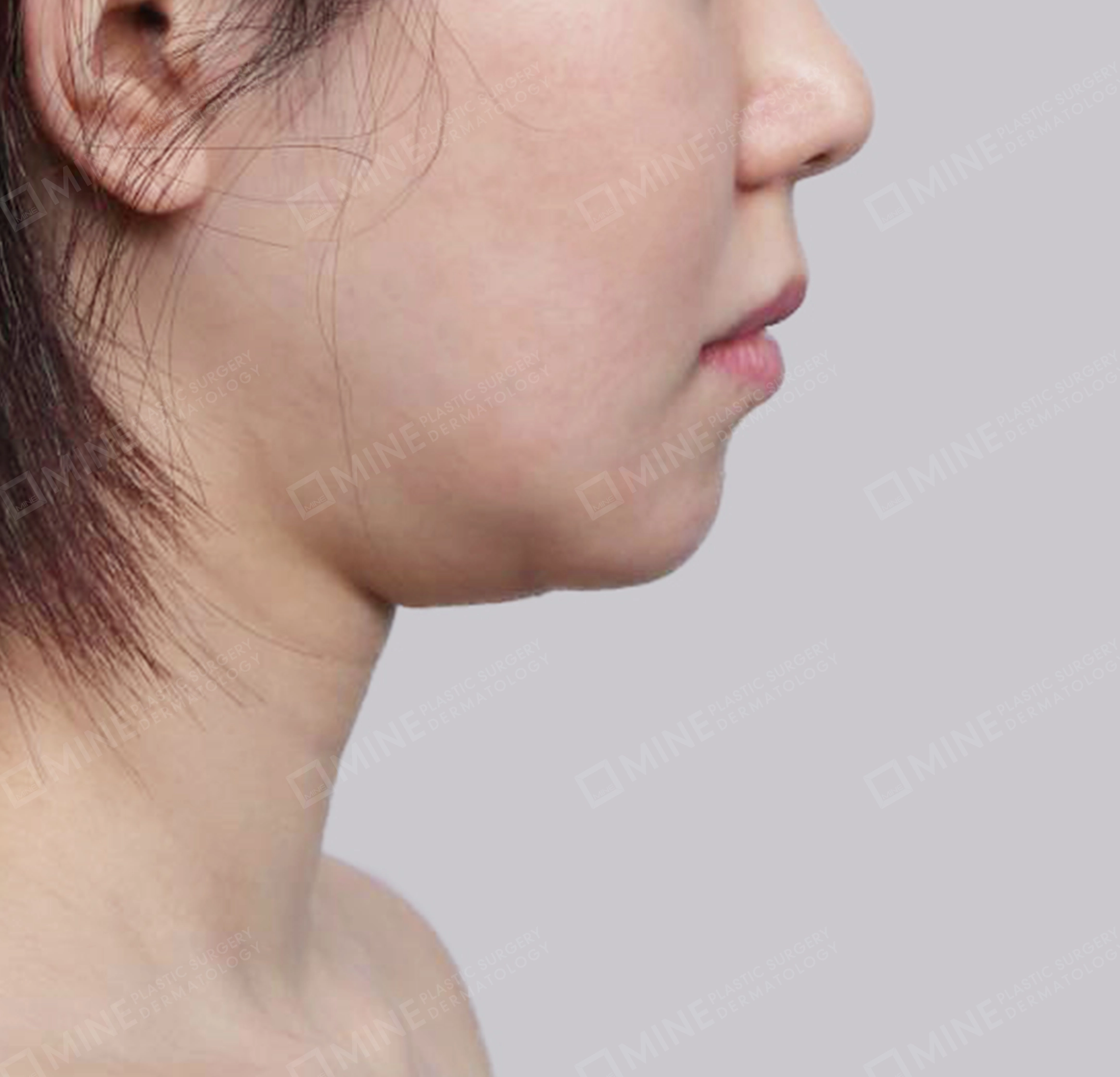 Vlimming (Dagu Ganda) + Eksisi kelenjar submandibula-Samping-Sebelum