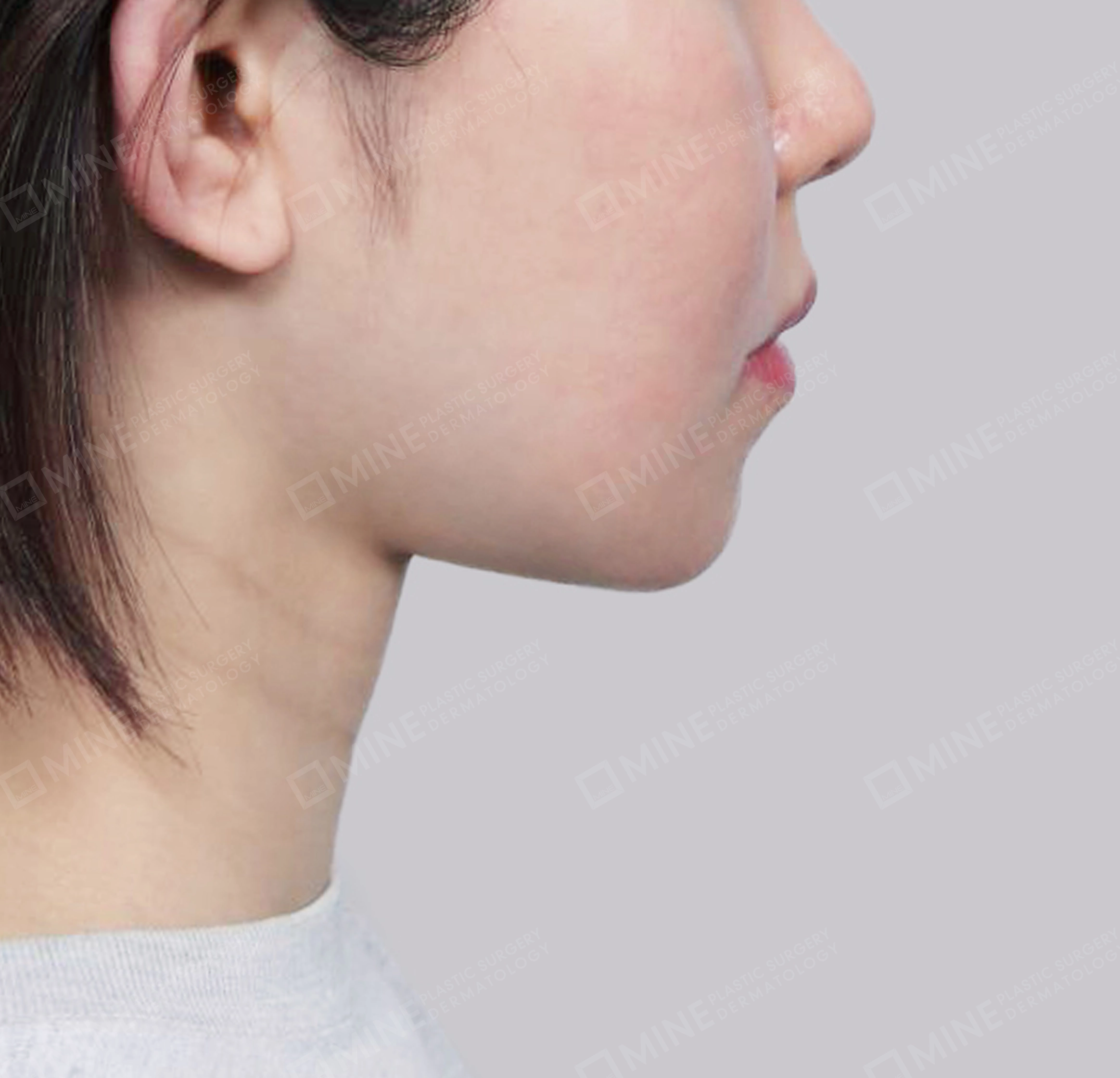 Vlimming (Dagu Ganda) + Eksisi kelenjar submandibula-Samping-Sesudah