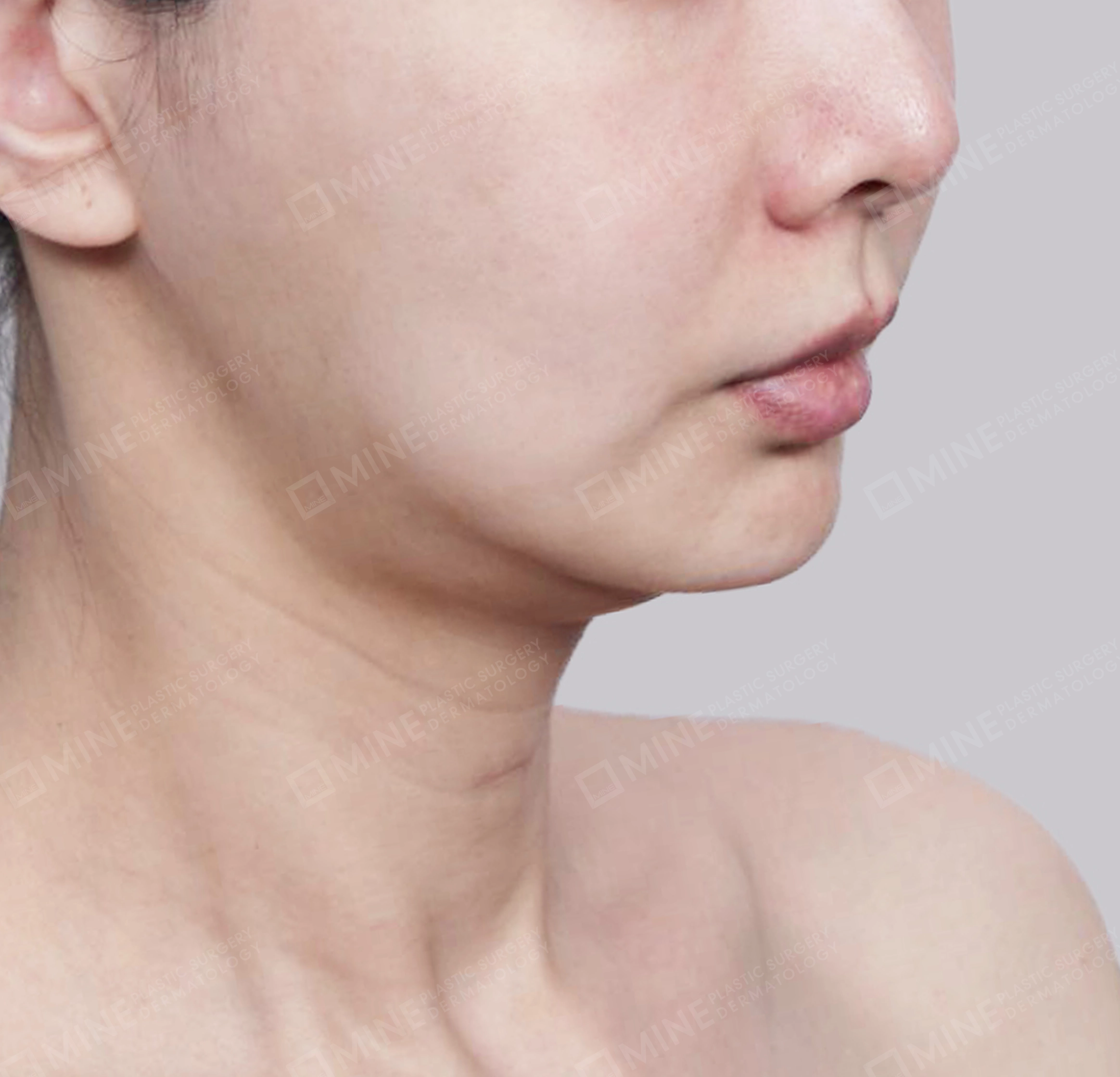 Vlimming (Dagu Ganda) + Eksisi kelenjar submandibula-Depan-Sebelum