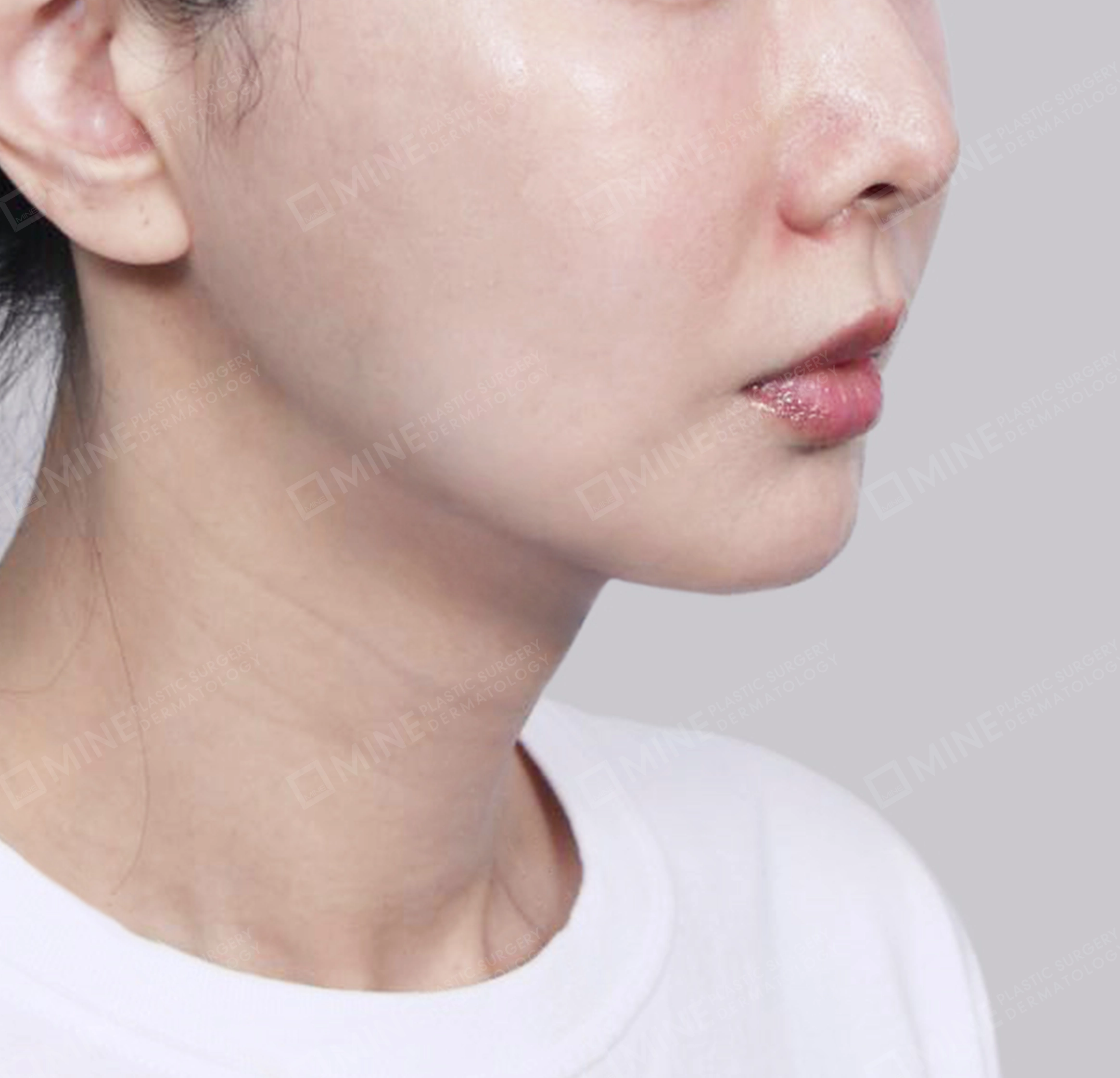 Vlimming (Dagu Ganda) + Eksisi kelenjar submandibula-Depan-Sesudah