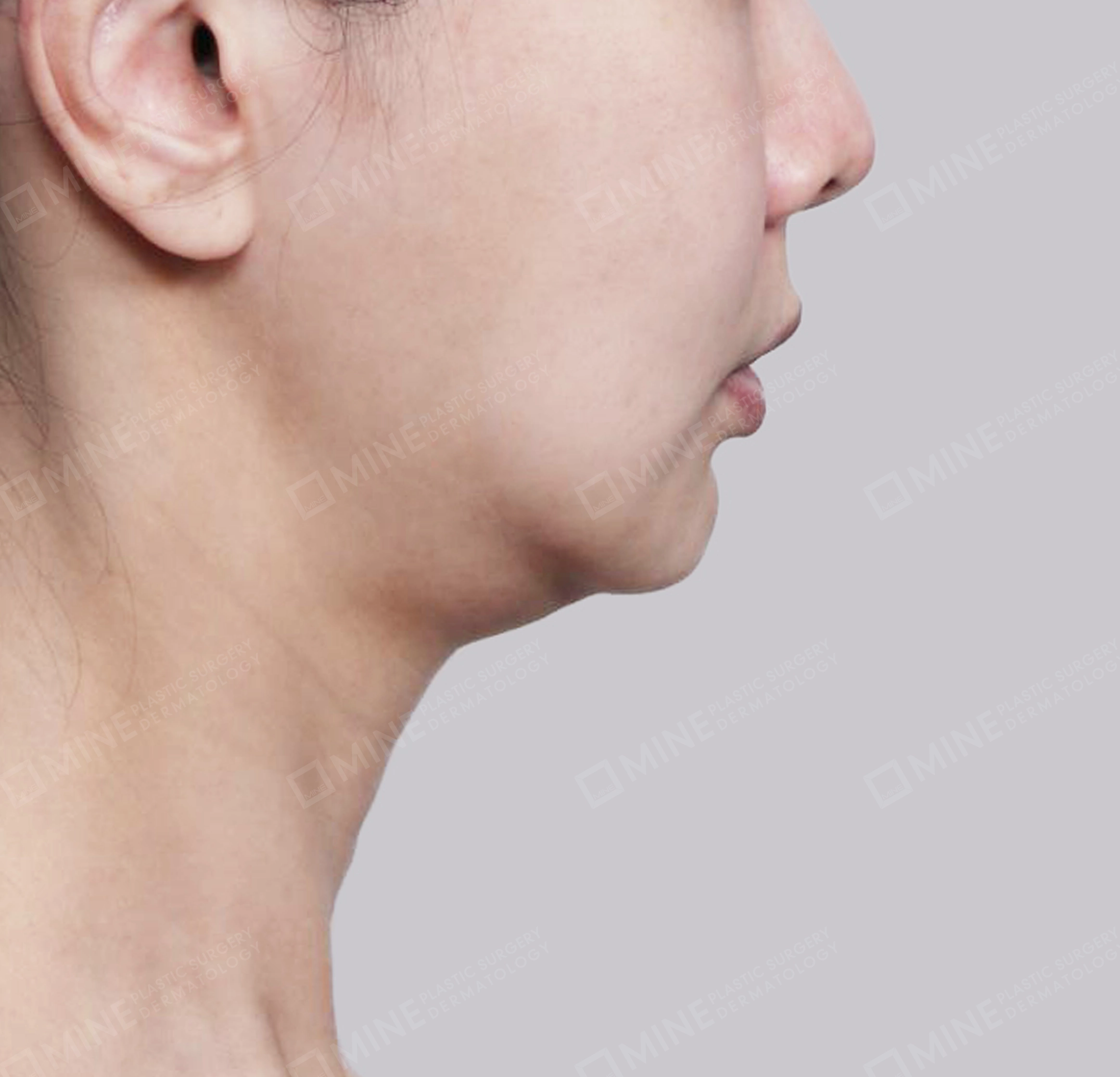 Vlimming (Dagu Ganda) + Eksisi kelenjar submandibula-Samping-Sebelum
