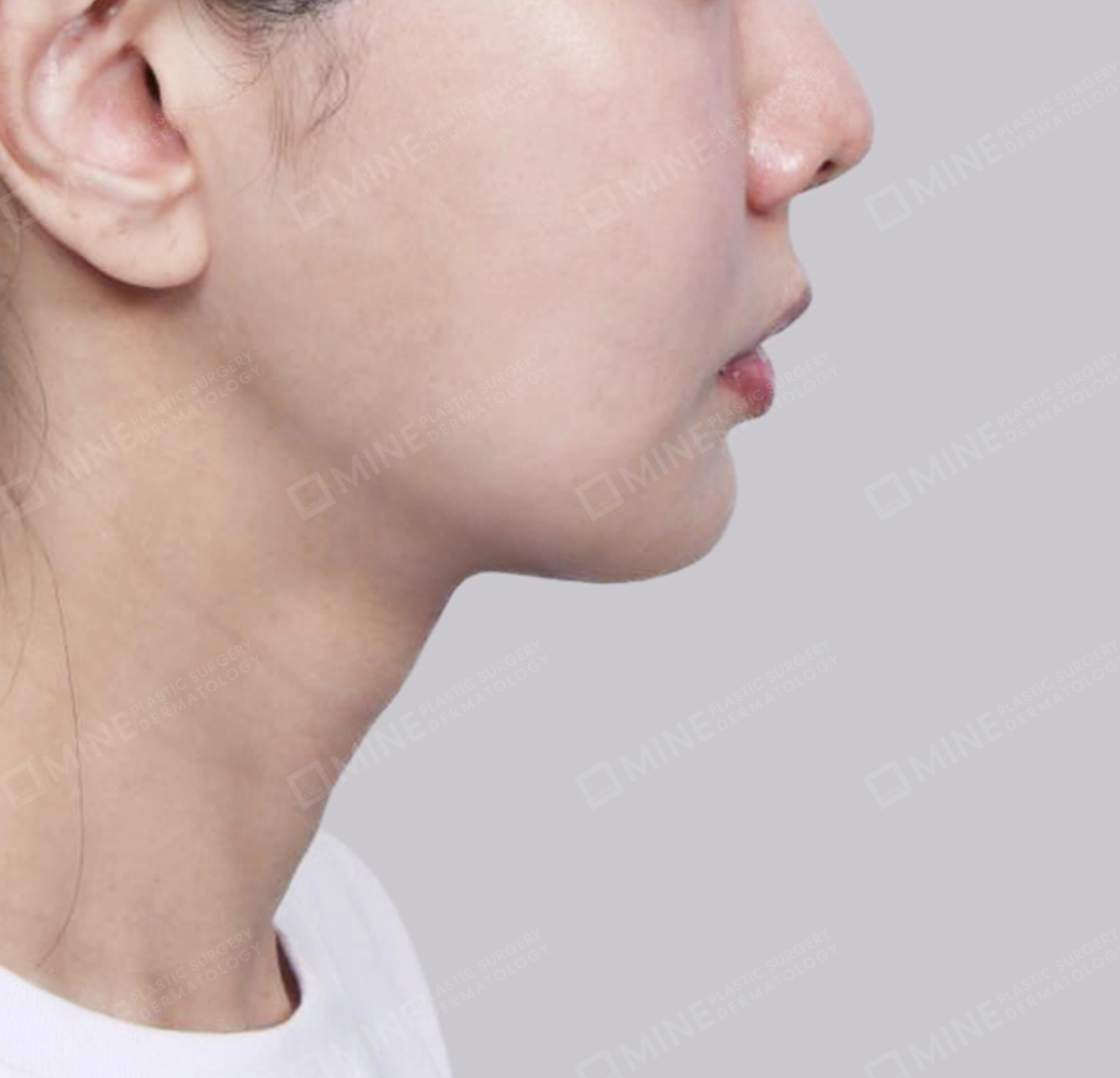 Vlimming (Dagu Ganda) + Eksisi kelenjar submandibula-Samping-Sesudah