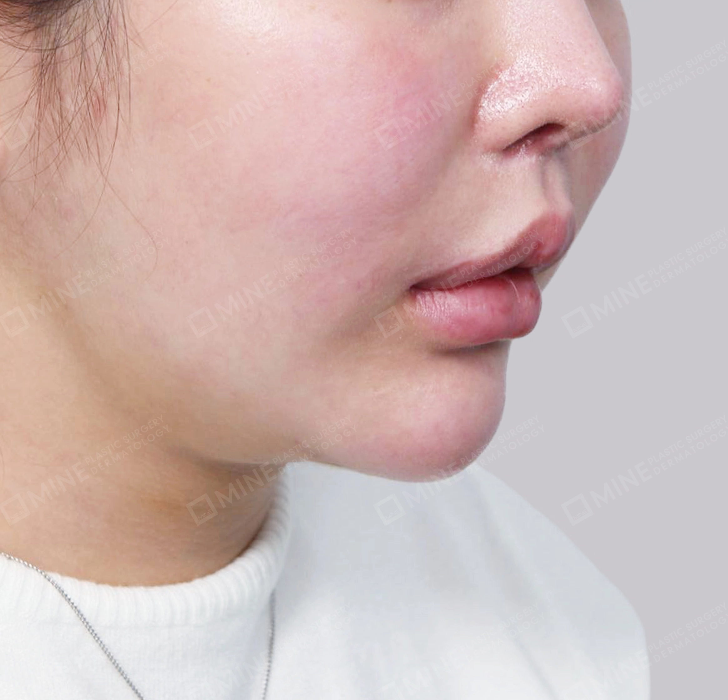 Vlimming (Dagu Ganda) + Eksisi kelenjar submandibula-Depan-Sebelum