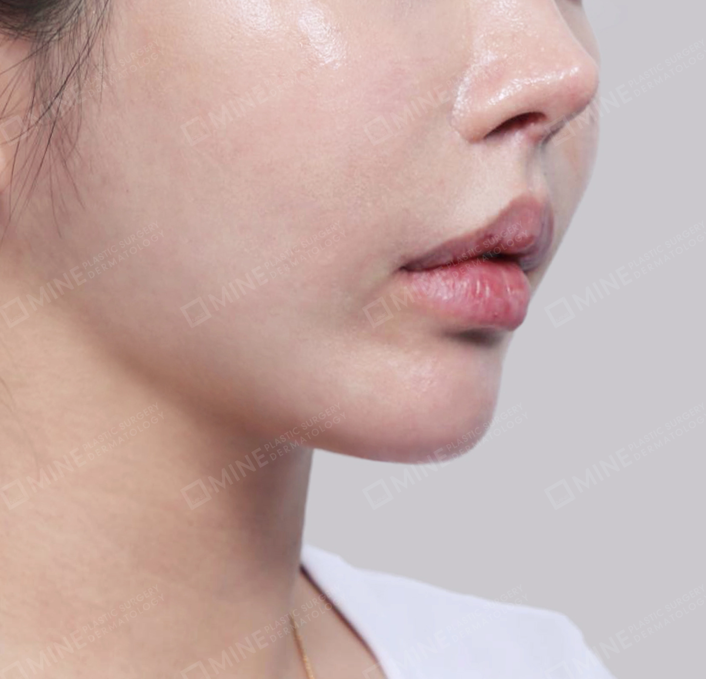 Vlimming (Dagu Ganda) + Eksisi kelenjar submandibula-Depan-Sesudah