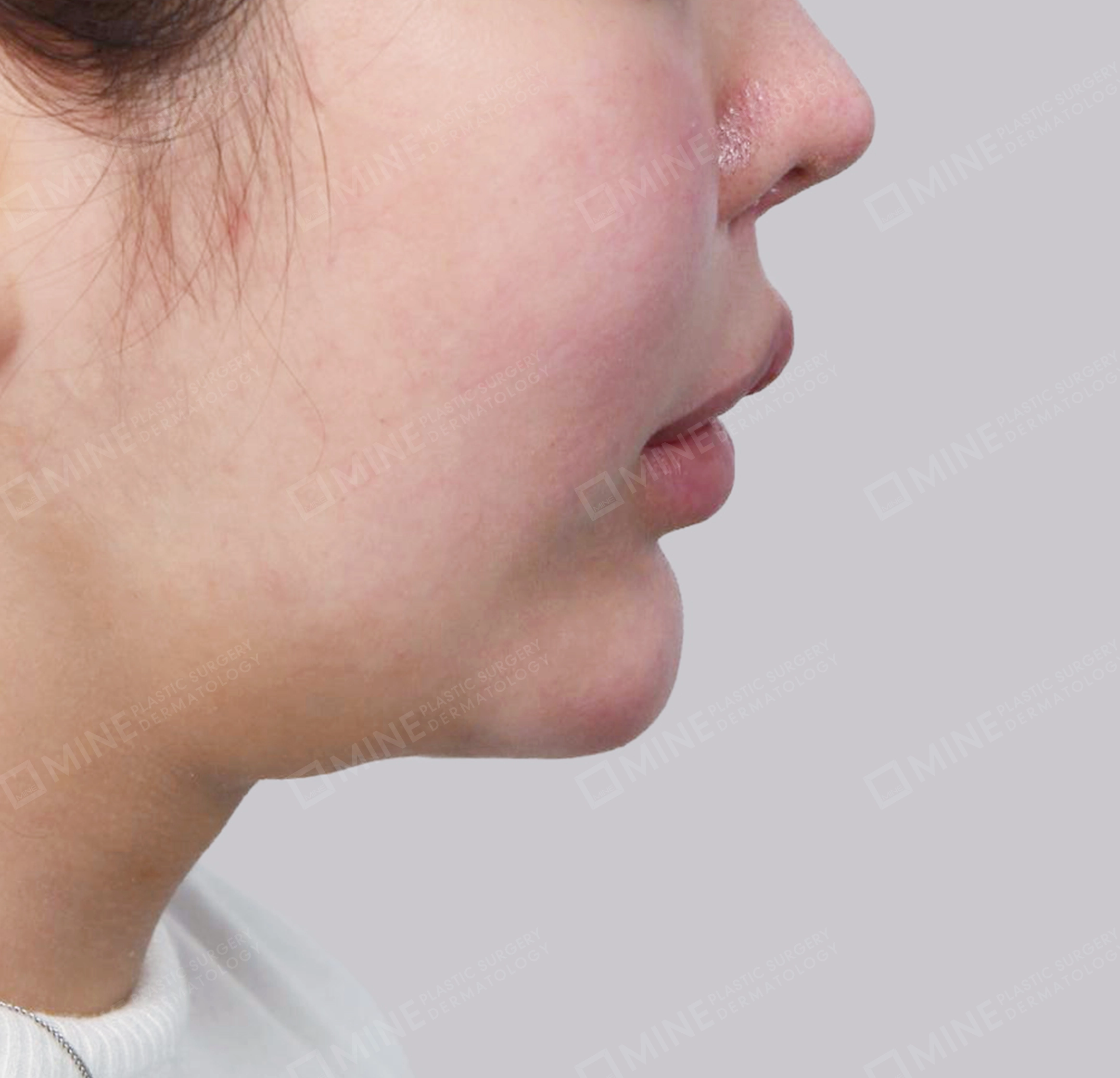 Vlimming (Dagu Ganda) + Eksisi kelenjar submandibula-Samping-Sebelum