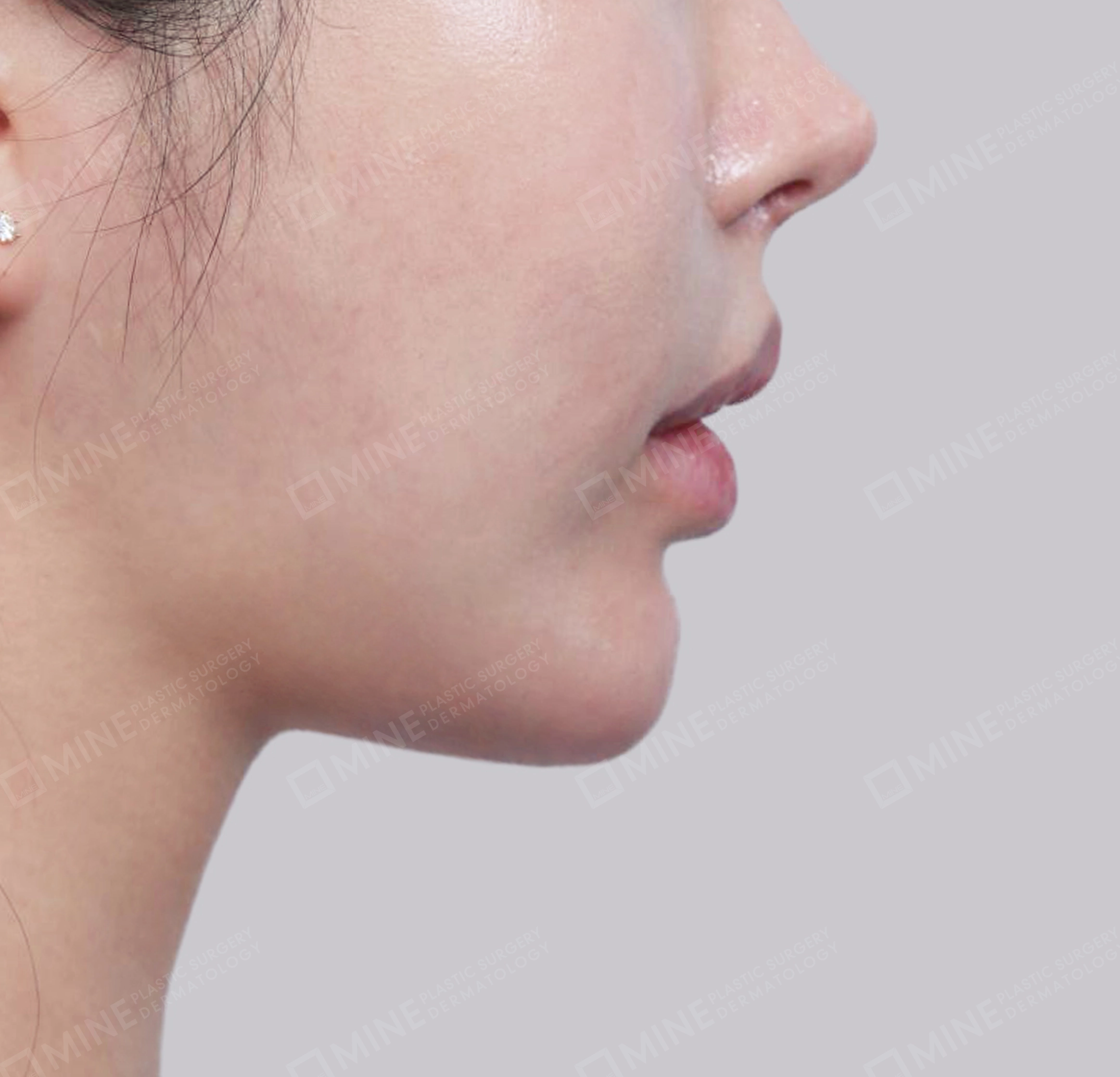 Vlimming (Dagu Ganda) + Eksisi kelenjar submandibula-Samping-Sesudah