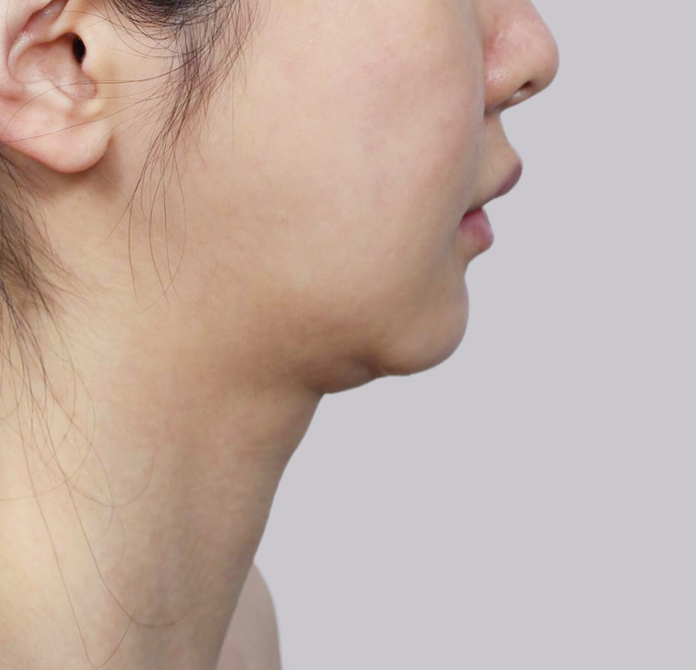 Mini Facelift-Samping-Sebelum
