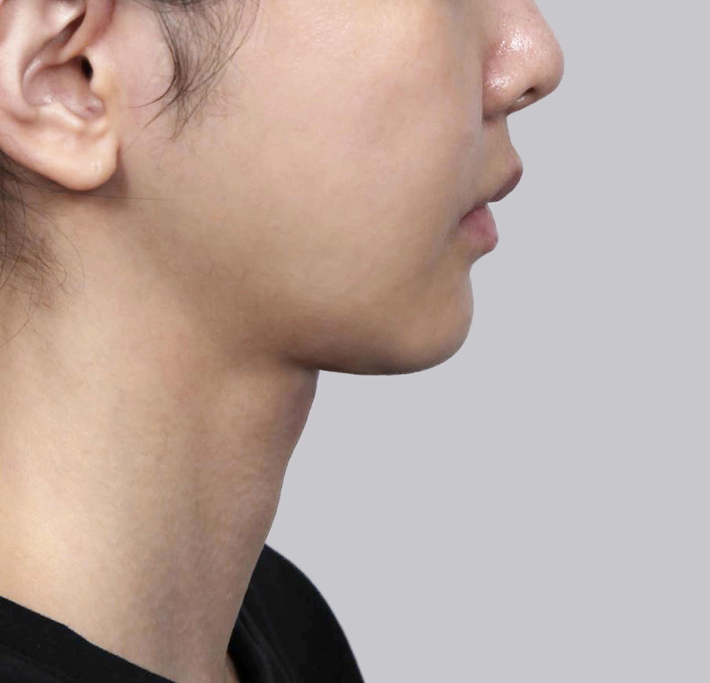 Mini Facelift-Samping-Sesudah