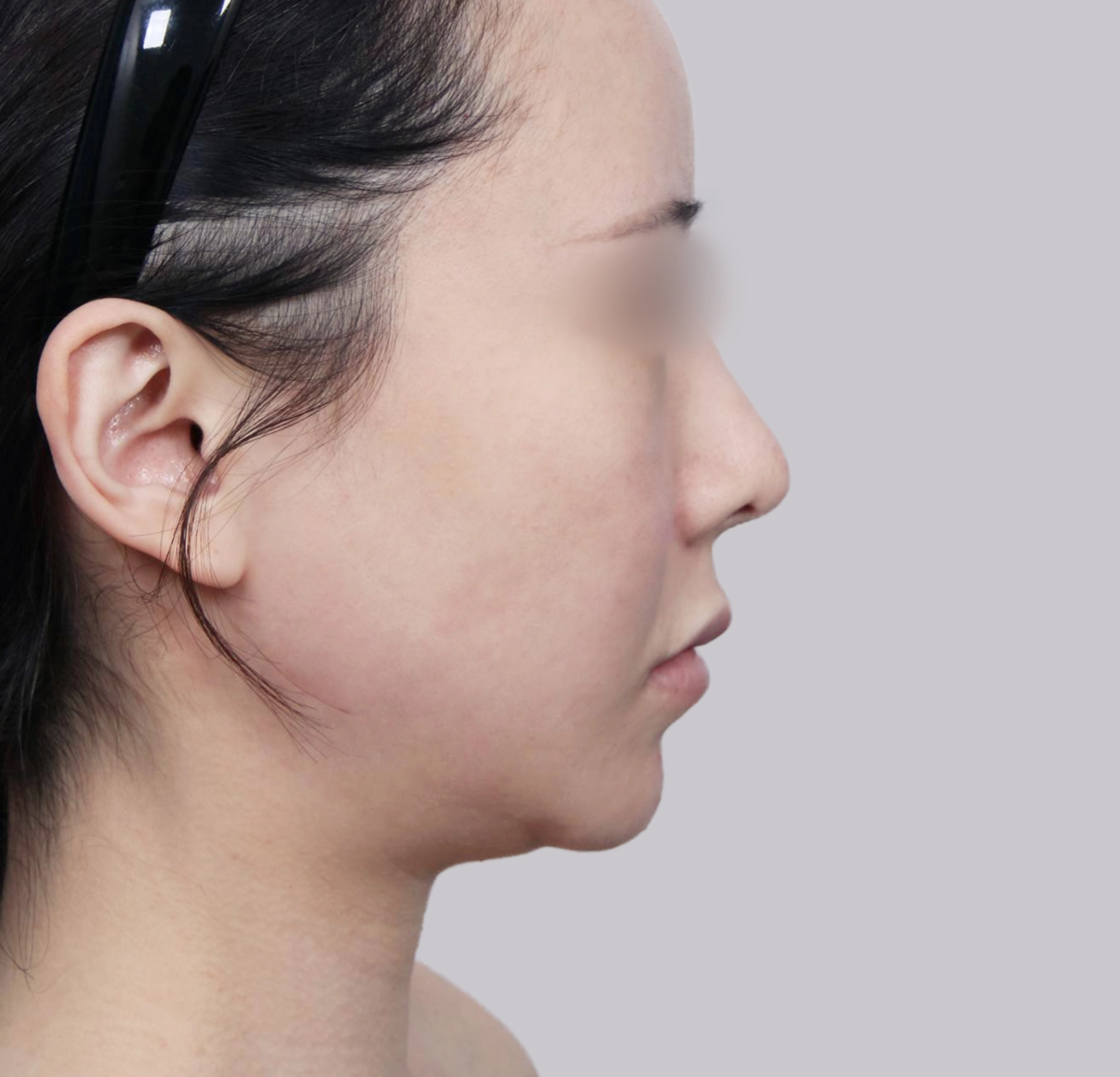 Mini Facelift-Samping-Sebelum