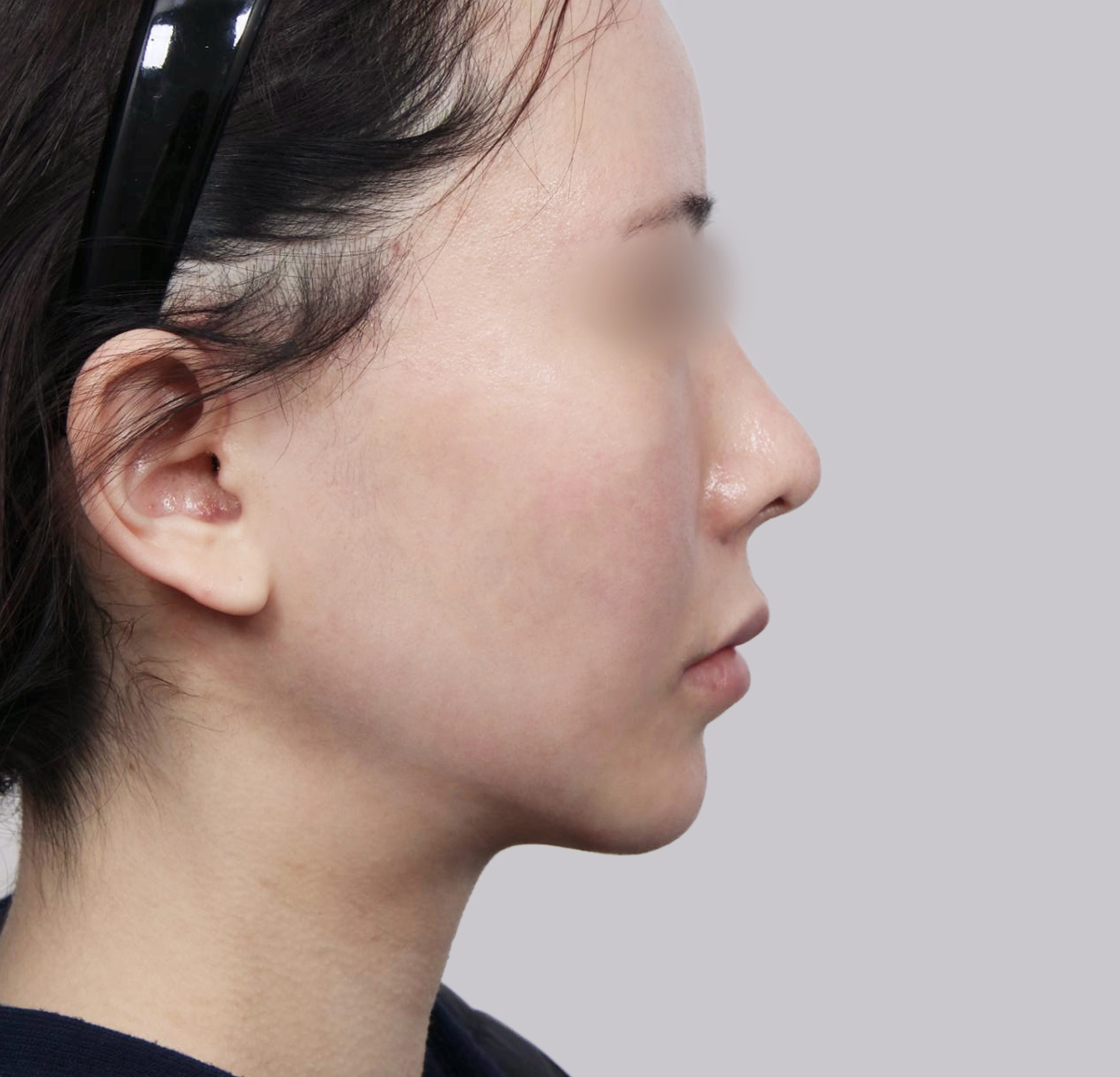 Mini Facelift-Samping-Sesudah