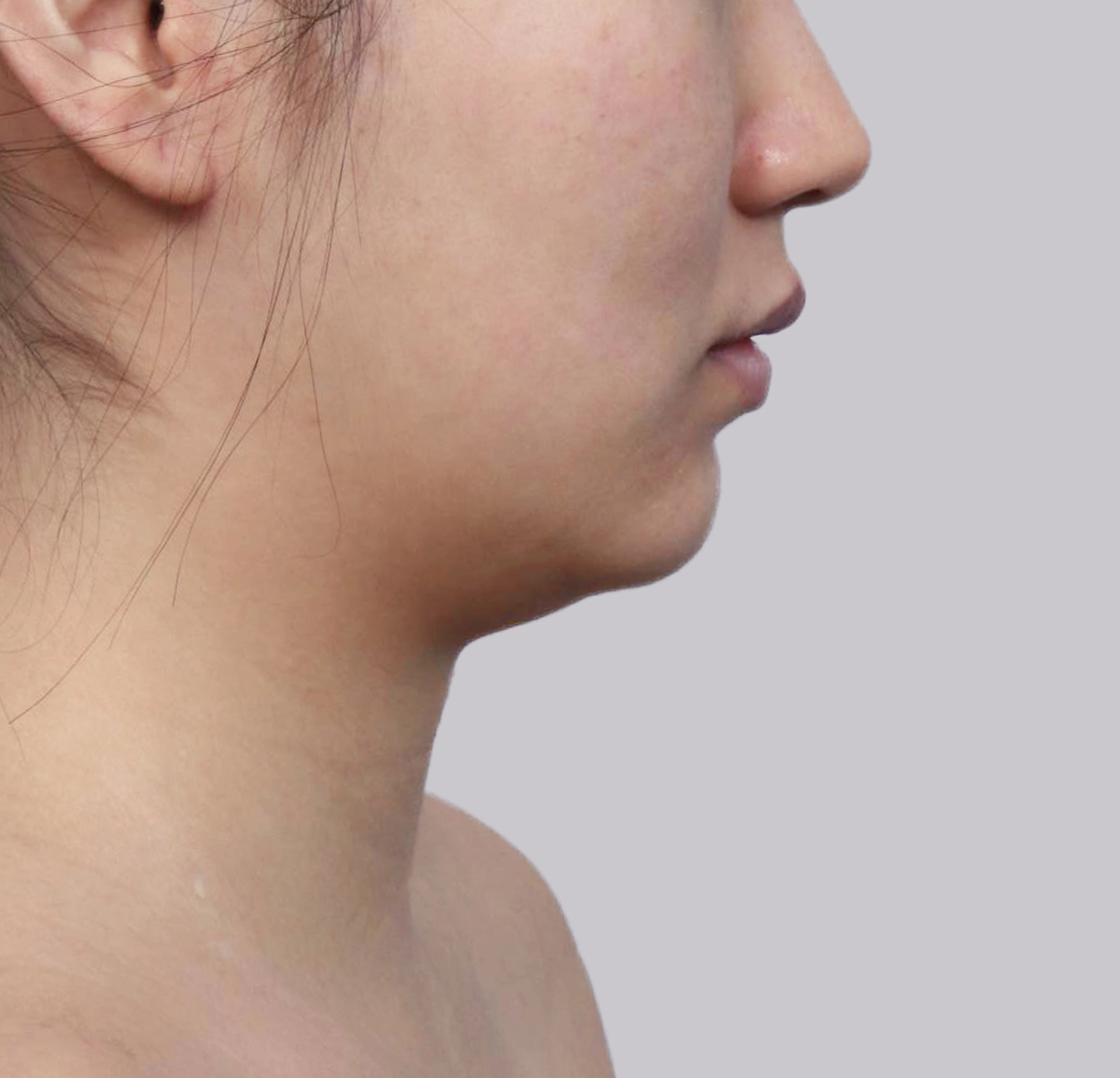 Mini Facelift-Samping-Sebelum