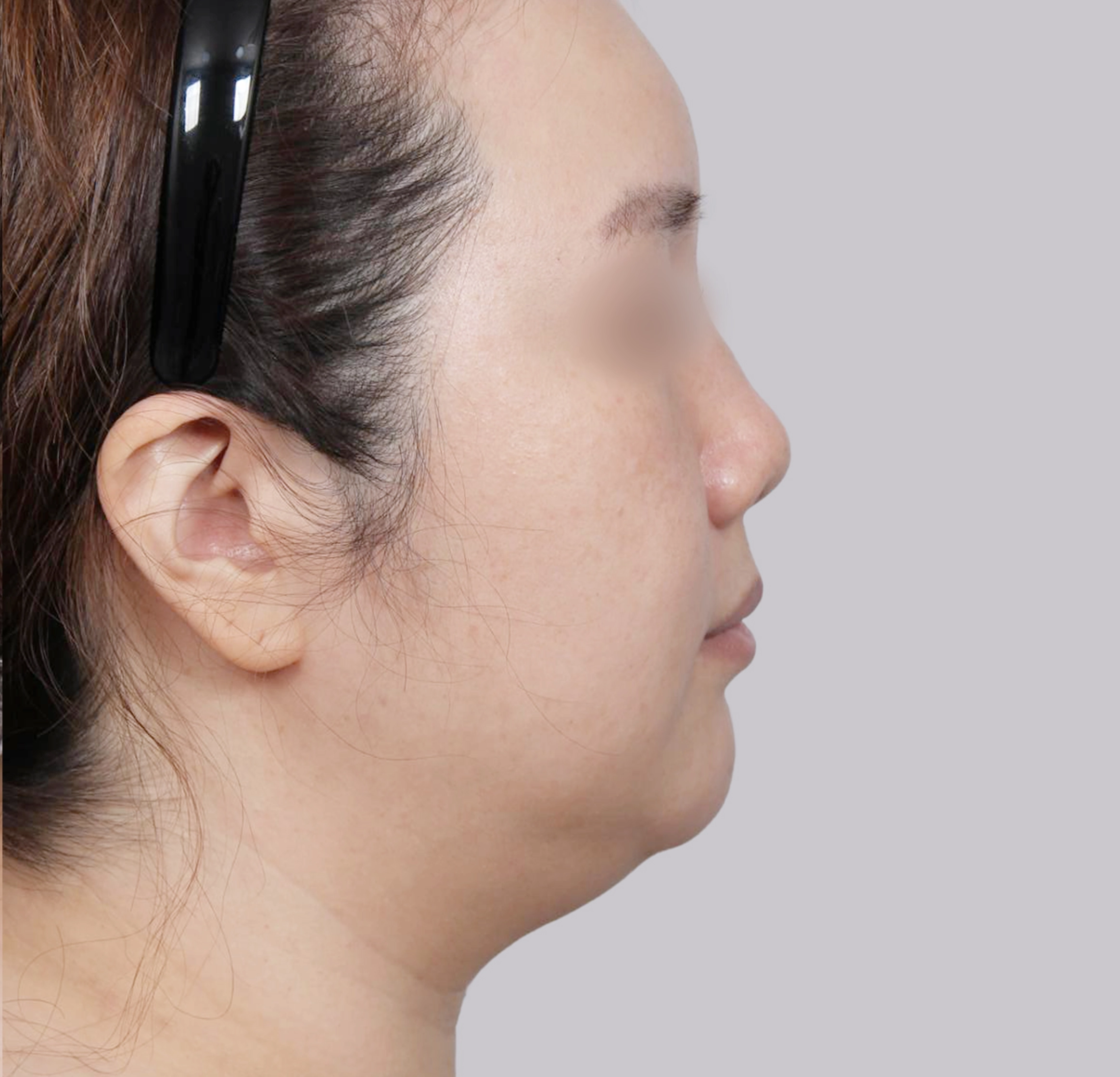 Mini Facelift-Samping-Sebelum