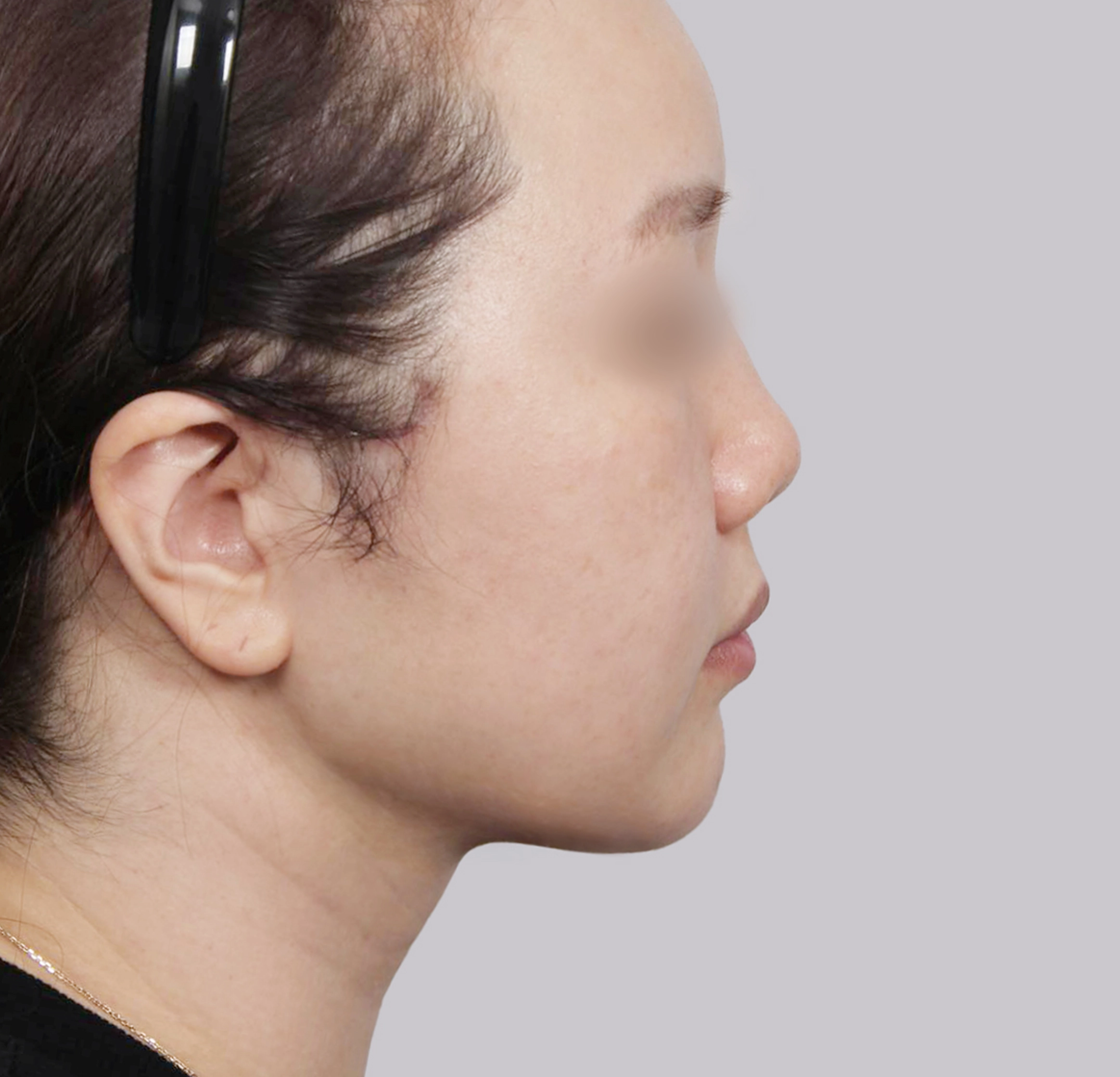 Mini Facelift-Samping-Sesudah
