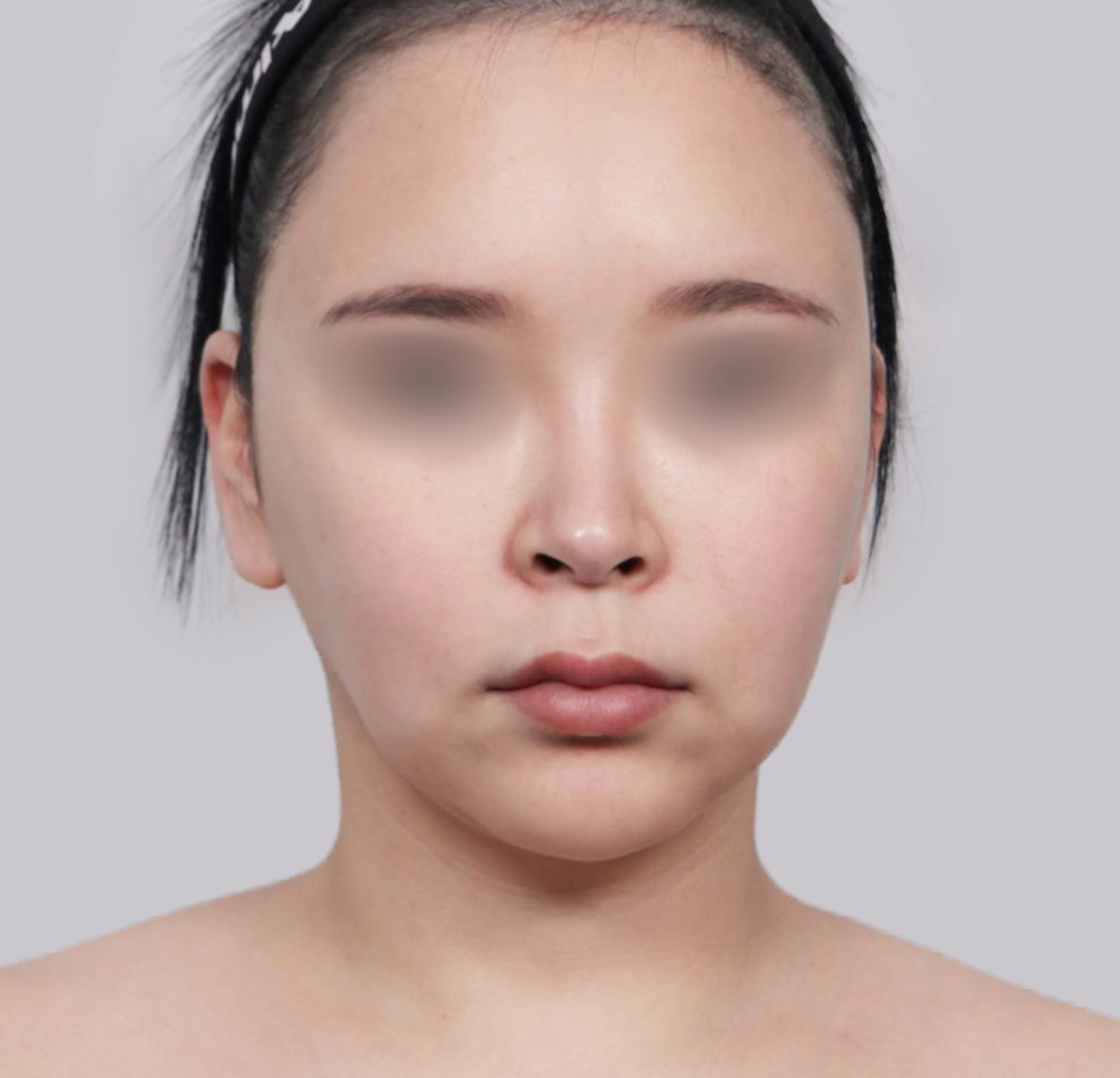 Mini Facelift-Depan-Sebelum