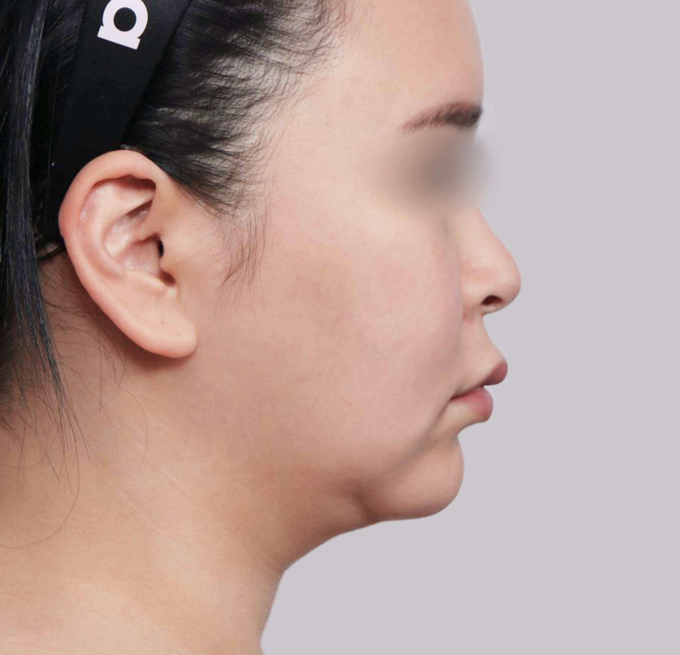 Mini Facelift-Samping-Sebelum
