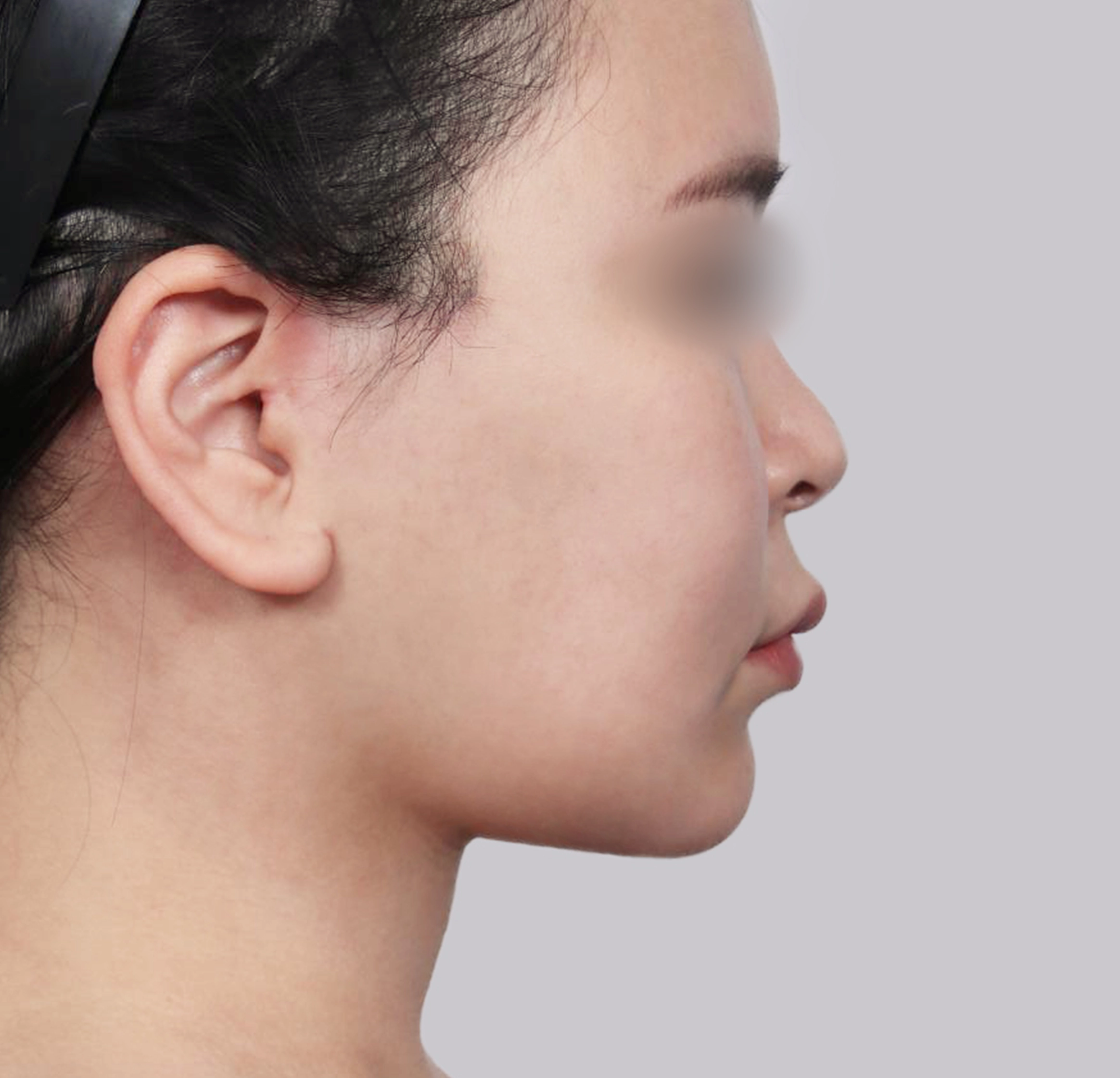 Mini Facelift-Samping-Sesudah