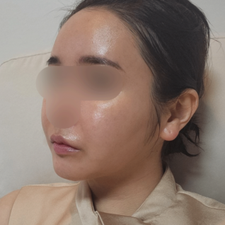 Pengikatan otot dagu + Sedot lemak pipi + Pengangkatan lemak bukal + Mini lifting + Lifting leher