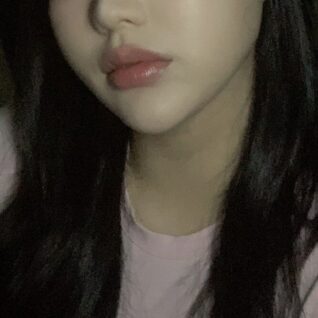 Pengikatan otot dagu + Sedot lemak pipi