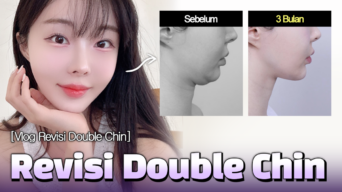 [Vlog] Revisi Double Chin | #plasticsurgerykorea