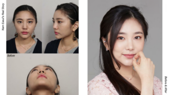[Dermatologi MINE] Rhinoplasty dan Perawatan Lifting Sebelum & Sesudah