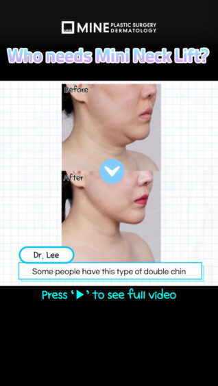 Operasi double chin nggak bisa? Mini facelift bisa jadi solusi! 🙆‍♀️