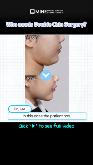 Operasi double chin itu wajib? ❌ Nggak selalu!❌ Ada jenis double chin yang memang perlu operasi khusus!