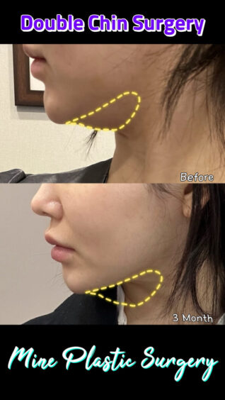 Cuma atur garis rahang, bisa secantik ini? 🎀 Real story setelah Double Chin