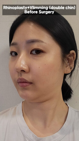 ✨ Review hasil operasi rinoplasti+double chin dari staff klinik! ✨